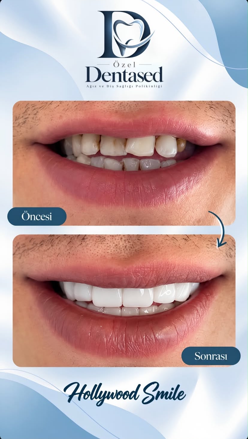 DentaSed gülüş dönüşümü vakasının öncesi ve sonrası