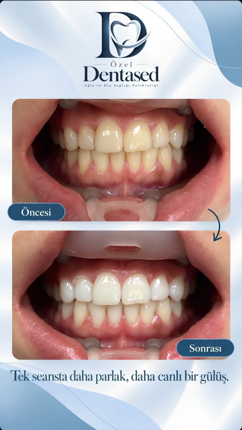 DentaSed diş beyazlatma vakasının öncesi ve sonrası
