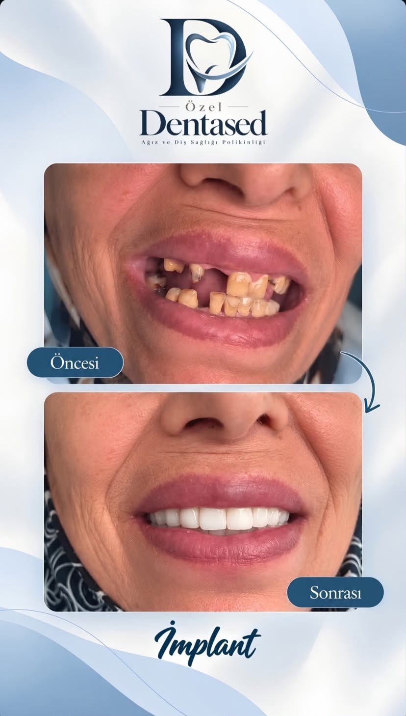 DentaSed implant tedavisi vakasının öncesi ve sonrası