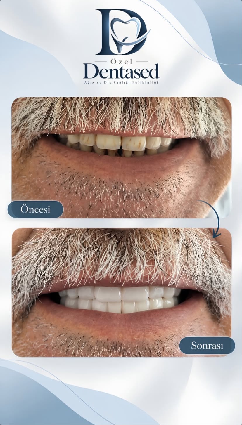 DentaSed gülüş dönüşümü vakasının öncesi ve sonrası
