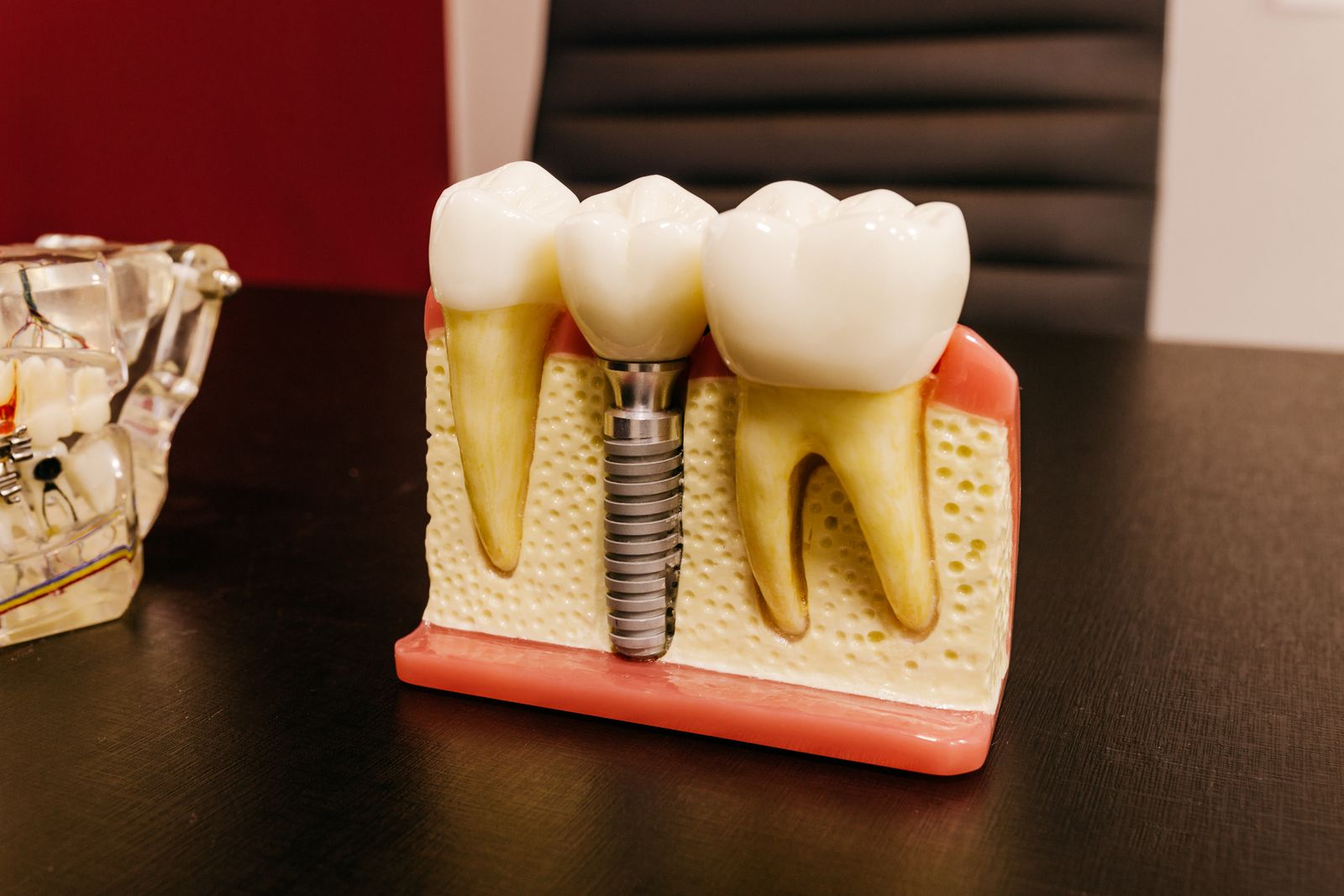 Dental implantı gösteren eğitim amaçlı çene modeli